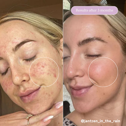 Blume Acne Treat & Fade Bundle