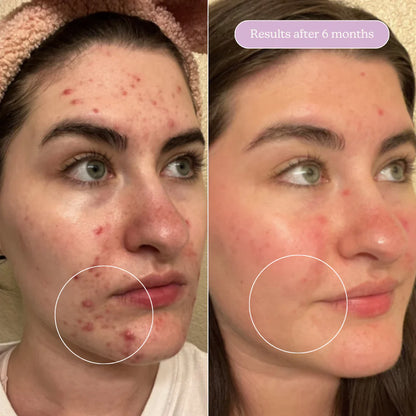 Blume Acne Treat & Fade Bundle