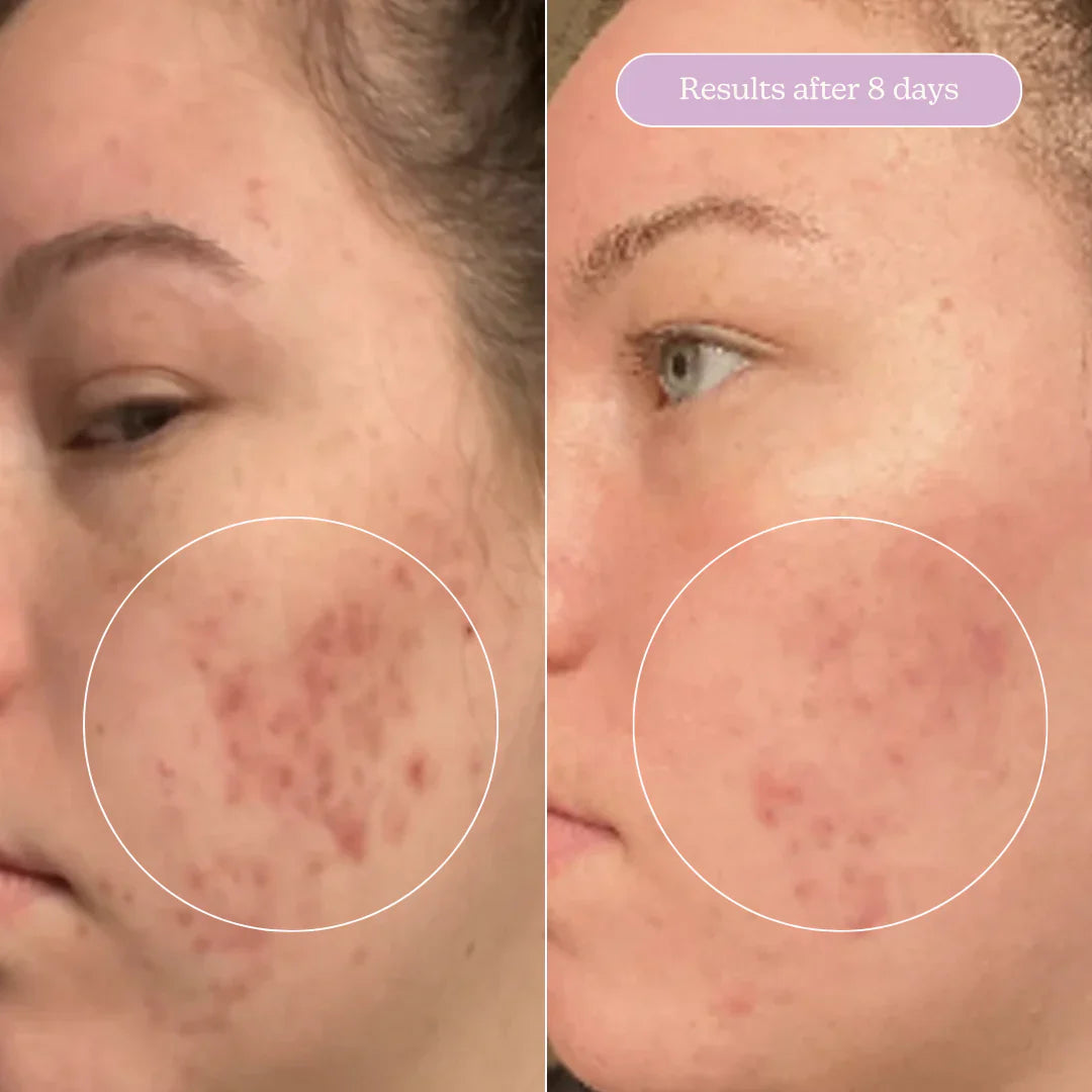 Blume Acne Treat & Fade Bundle