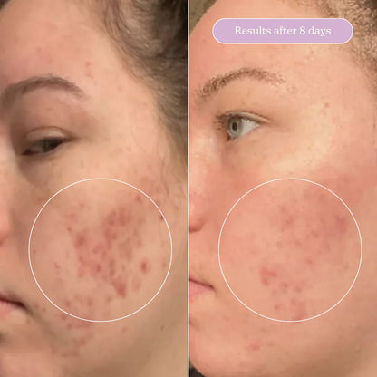 Blume Acne Treat & Fade Bundle