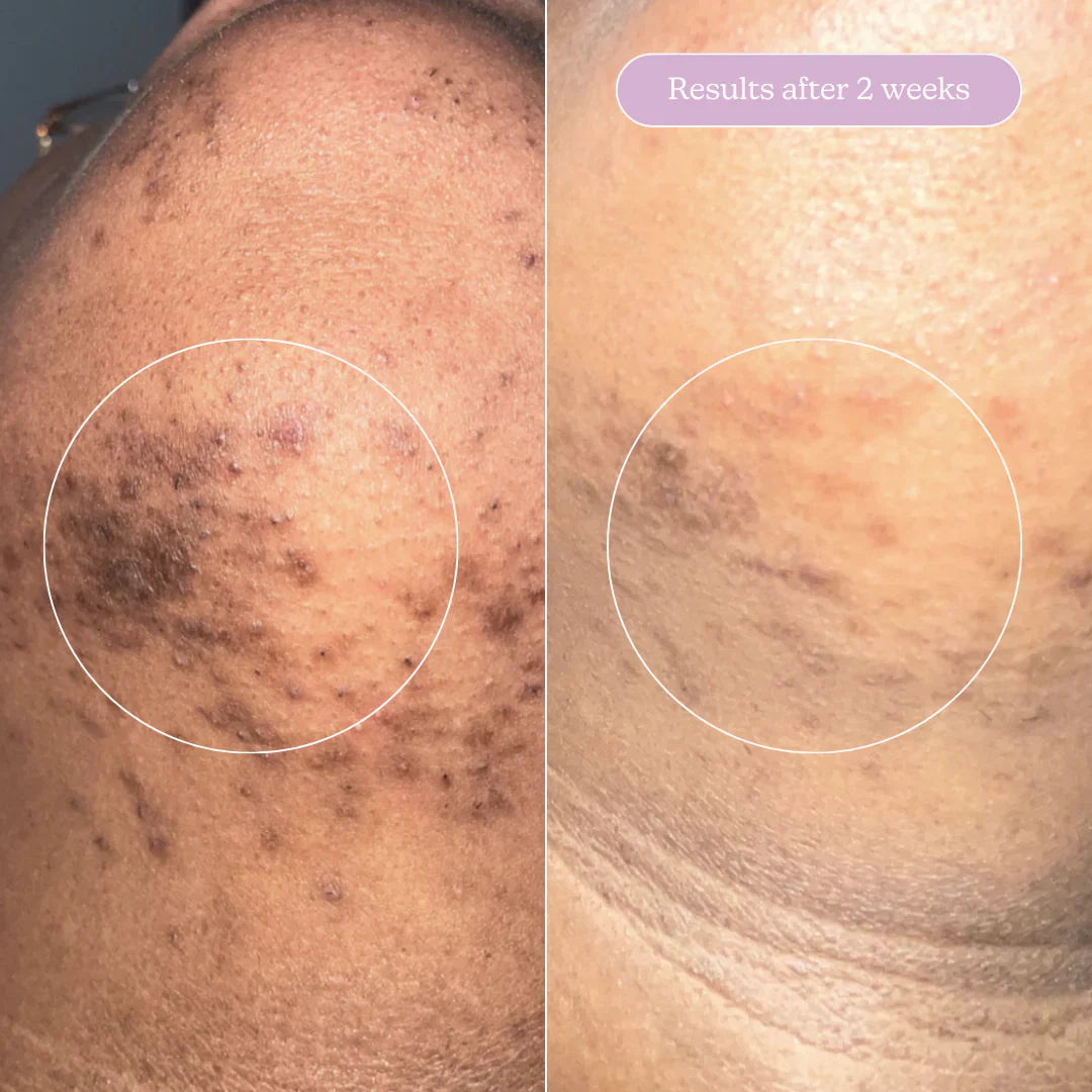 Blume Acne Treat & Fade Bundle